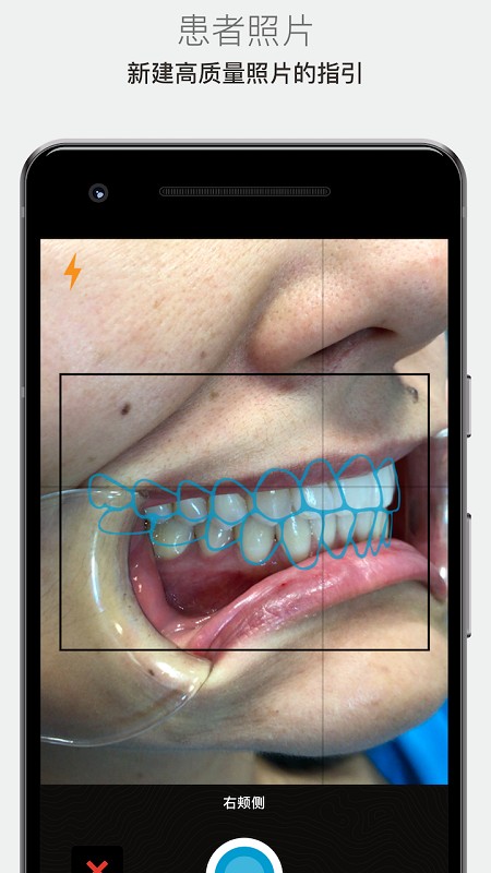invisalign矫治器(IPU)